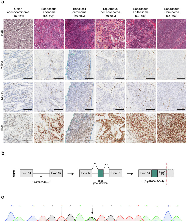 jidinnovations's tweet image. From the March 2026 issue: Deep intronic #MSH2 variant confirms #Muir-Torre subtype of #LynchSyndrome ow.ly/Wfm550XN5XC #medderm #dermtwitter