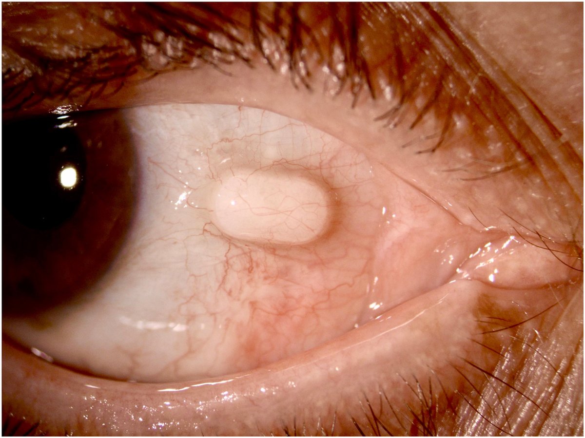 aao_ophth's tweet photo. A patient presented with an unusual case of a nasal subconjunctival Mydriasert insert in the right eye, detected 3 weeks after uneventful cataract surgery. The insert had been placed pre-operatively to achieve mydriasis, and sub-Tenon’s anesthesia was performed in the inferonasal quadrant. At the routine postoperative visit, the patient was asymptomatic and satisfied with the visual outcome but noted a small nasal conjunctival swelling. Slit-lamp examination revealed the Mydriasert insert within the subconjunctival space, which was removed easily under aseptic conditions at the slit lamp. The most likely mechanism was migration of the insert through the sub-Tenon entry site created during anesthesia. This case highlights the importance of confirming removal of the Mydriasert insert before surgery and carefully inspecting the conjunctival fornices thereafter to prevent retention and possible postoperative complications.

From “Subconjunctival Retention of a Mydriasert Insert after Cataract Surgery” by Filomena Palmieri, MD and Vincenzo Maurino, MD. Published by Ophthalmology online on January 7, 2026.

Read: https://t.co/VP7gjHjQDK

#AAO