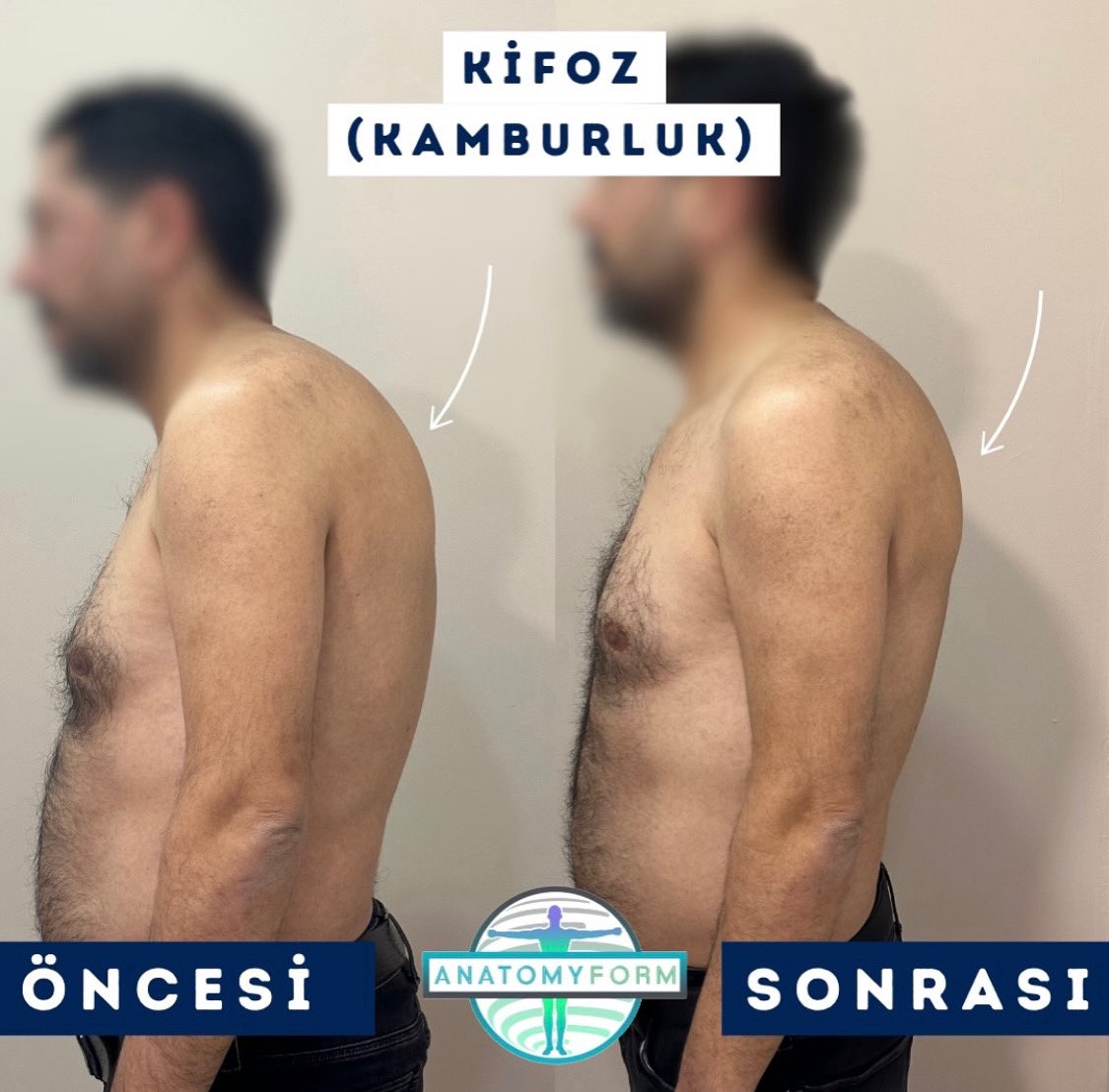 anatomyform's tweet photo. 📌DETAYLI BİLGİ ALMAK VE RANDEVU OLUŞTURMAK İÇİN İLETİŞİM NUMARAMIZI ARAYABİLİRSİNİZ.
🇹🇷 +90 544 105 05 44
#anatomyform #fonksiyoneltıp #fizyoterapi #manuelterapi #kifoz https://t.co/VPJ9kJLEUP