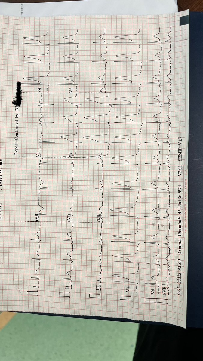 ALn3my's tweet photo. هذا مريض اليوم في الطوارئ:

Central chest pain for one hour ⏱️ 
Troponin = 13 ng/L (0–14 طبيعي)

وهذا ECG👇
What’s the diagnosis?

#MedTwitter #Cardiology #ECG https://t.co/oviQT7jLJw