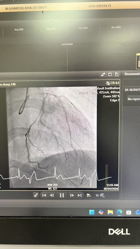 ALn3my's tweet photo. Coronary Angiograghy show

LAD = 100% occluded (mid segment) 🔥

طيب كيف Troponin  طبيعي؟ 🤔 https://t.co/T6I7nMdVZ8