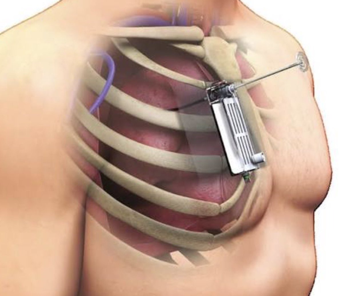 Pulmo_Logic's tweet photo. شايفين الجهاز اللي فالصورة؟ ايش تتوقعوا استخدامه؟
الـThora-Vent جهاز يُستخدم للPneumothorax البسيط. يتكون من One-way valve عشان يسمح للهواء بالخروج بدون ما يرجع يدخل
ميزته انه اقل تداخل من أنبوب الصدر التقليدي، والمريض يقدر يرجع البيت بالجهاز عادي

بحط المصادر والبروتوكول تحت https://t.co/K2Bzy4kWh5