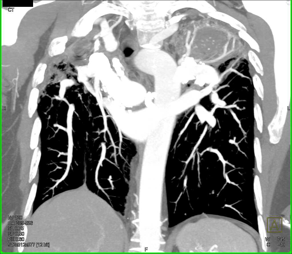 ctisus's tweet image. Sarcoidosis with Interstitial Fibrosis and Fungal Ball Left Upper Lobe: ctisus.com/teachingfiles/…