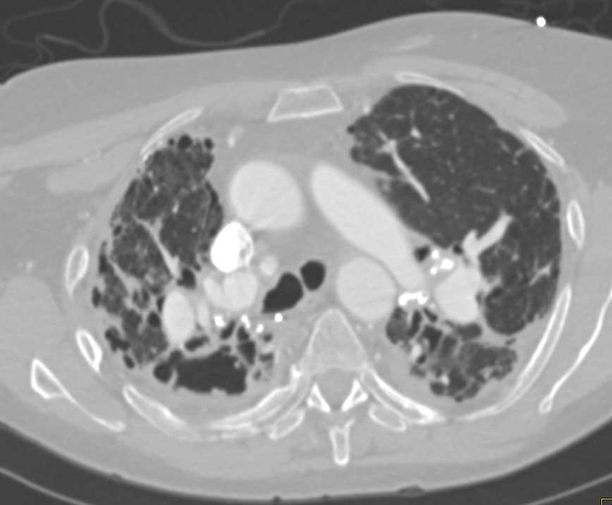 ctisus's tweet image. Sarcoidosis with Interstitial Fibrosis and Fungal Ball Left Upper Lobe: ctisus.com/teachingfiles/…