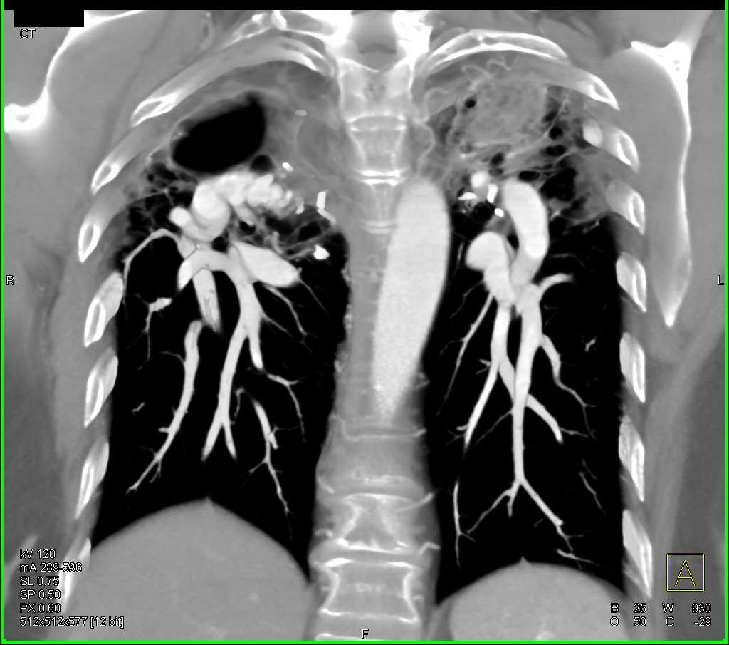 ctisus's tweet image. Sarcoidosis with Interstitial Fibrosis and Fungal Ball Left Upper Lobe: ctisus.com/teachingfiles/…