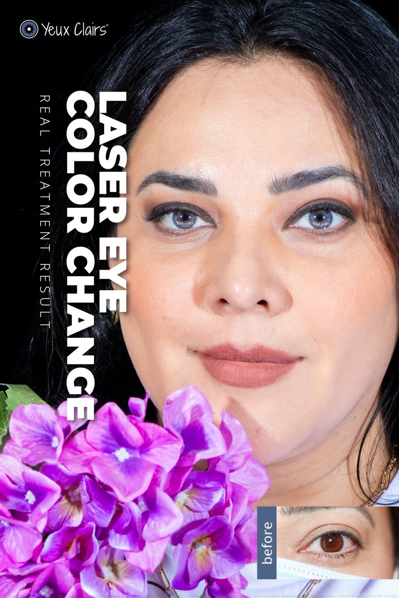 Fresh, floral, and fabulous. 💐😉

More results: yeuxclairs.com/gallery
#LaserEyeColorChange #PermanentResults #SafeAndPainless