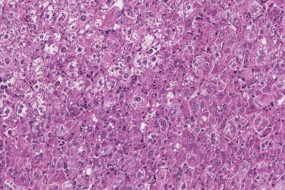 RockefellerUniv's tweet photo. The @RiceLaboratory has created the first mouse model that closely mirrors what happens when people with hepatitis C develop liver cancer, allowing scientists to study how liver virus infection leads to cancer as well as to test treatments.

🔗: https://t.co/PFA29AOM8b https://t.co/Ji1dazXxHm