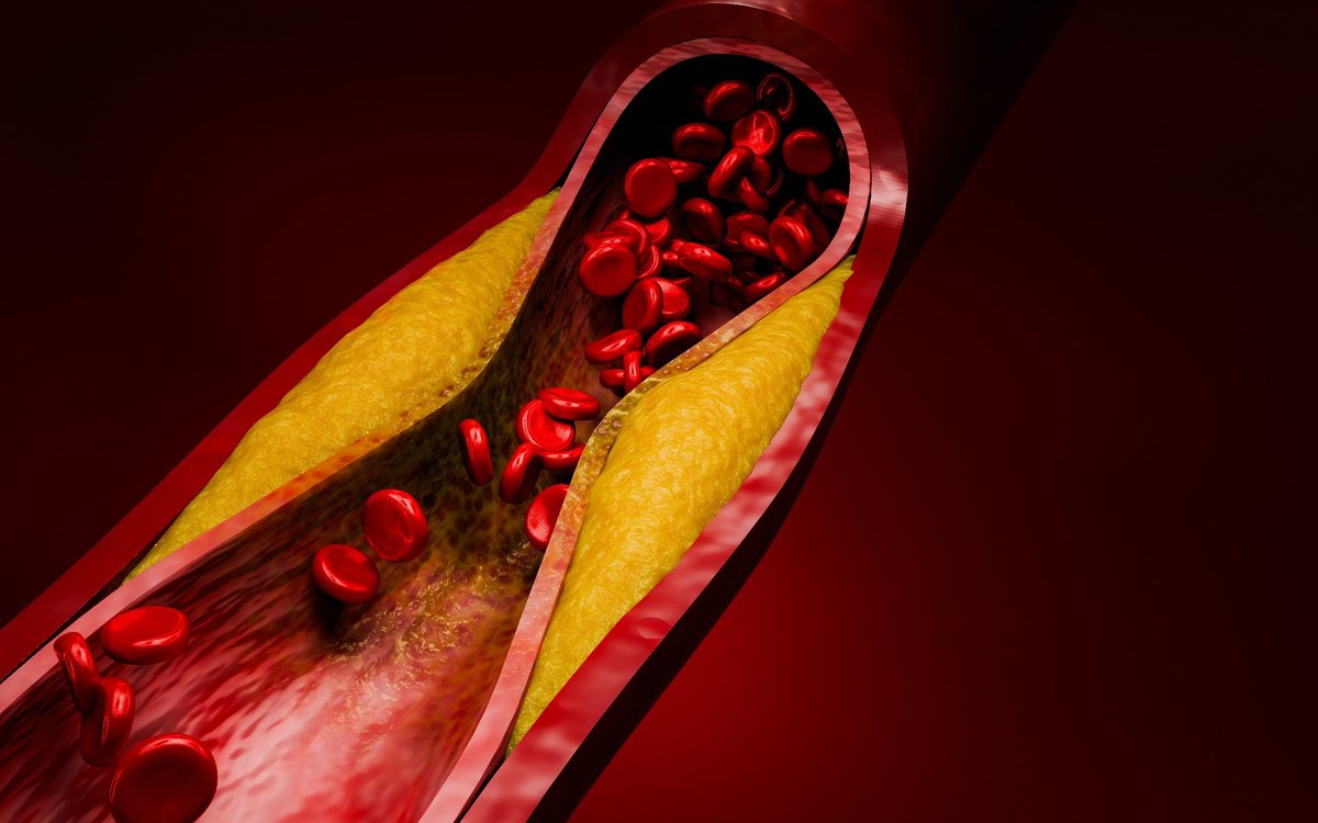 NewsMedical's tweet image. A groundbreaking trial of evolocumab could shift how doctors manage cholesterol for high-risk patients. New evidence may soon transform LDL targets and prevention strategies 🧬👀

 news-medical.net/news/20260406/… #Heart #Cholesterol @accintouch