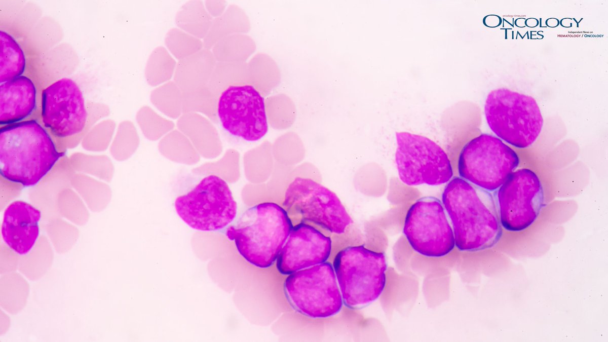 OncologyTimes's tweet image. Measurable residual disease after induction therapy may serve as a strong surrogate marker for survival in patients with acute myeloid leukemia, researchers report. ow.ly/9WfB50YEB6P #AML #CancerResearch #Hematology