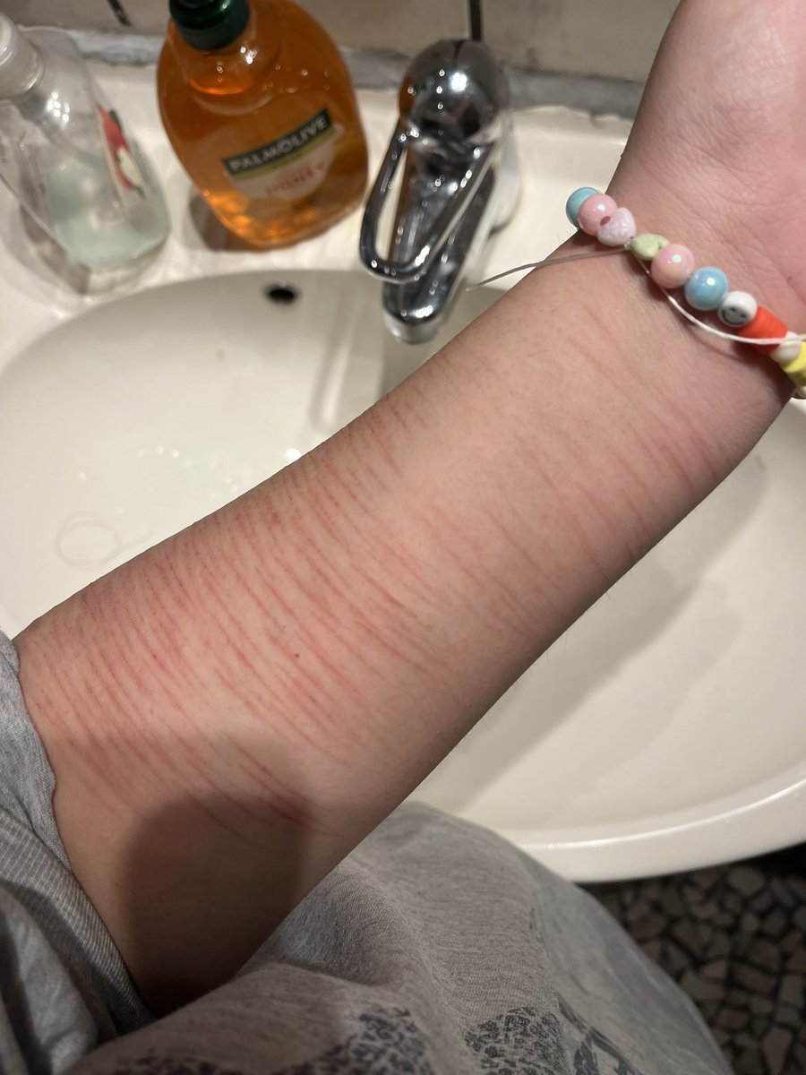 Healed baby styro/cat scratches (my arm looks like a chicken leg) #shtwt