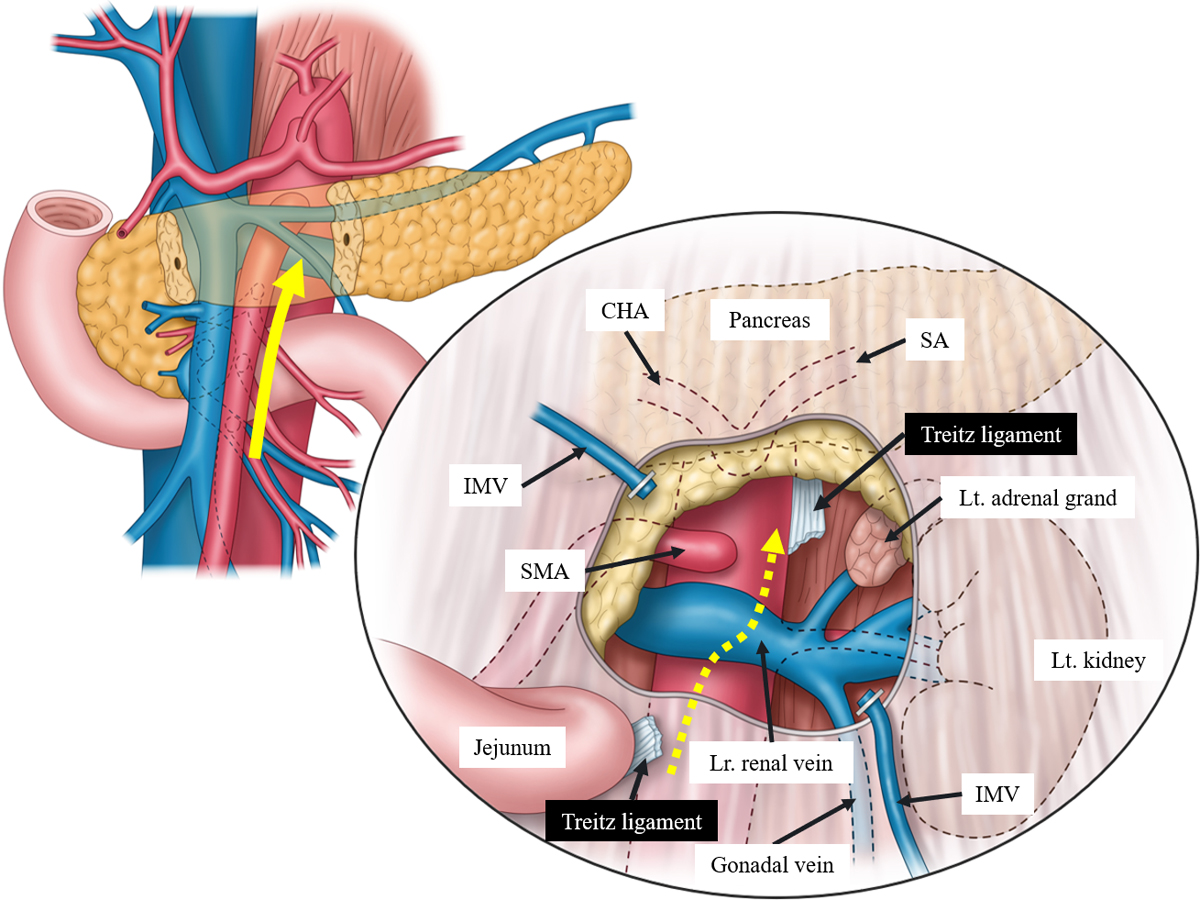 JSESイラコン 124
📌腹腔鏡下膵体尾部切除でのSMA左側アプローチ
📝腹腔鏡下膵体尾部切除における、Caudal viewを活かした後腹膜組織のen block切除の手順解説
🖊宮本 良一
#JSESイラストコンテスト　#JSES_illustration_contest