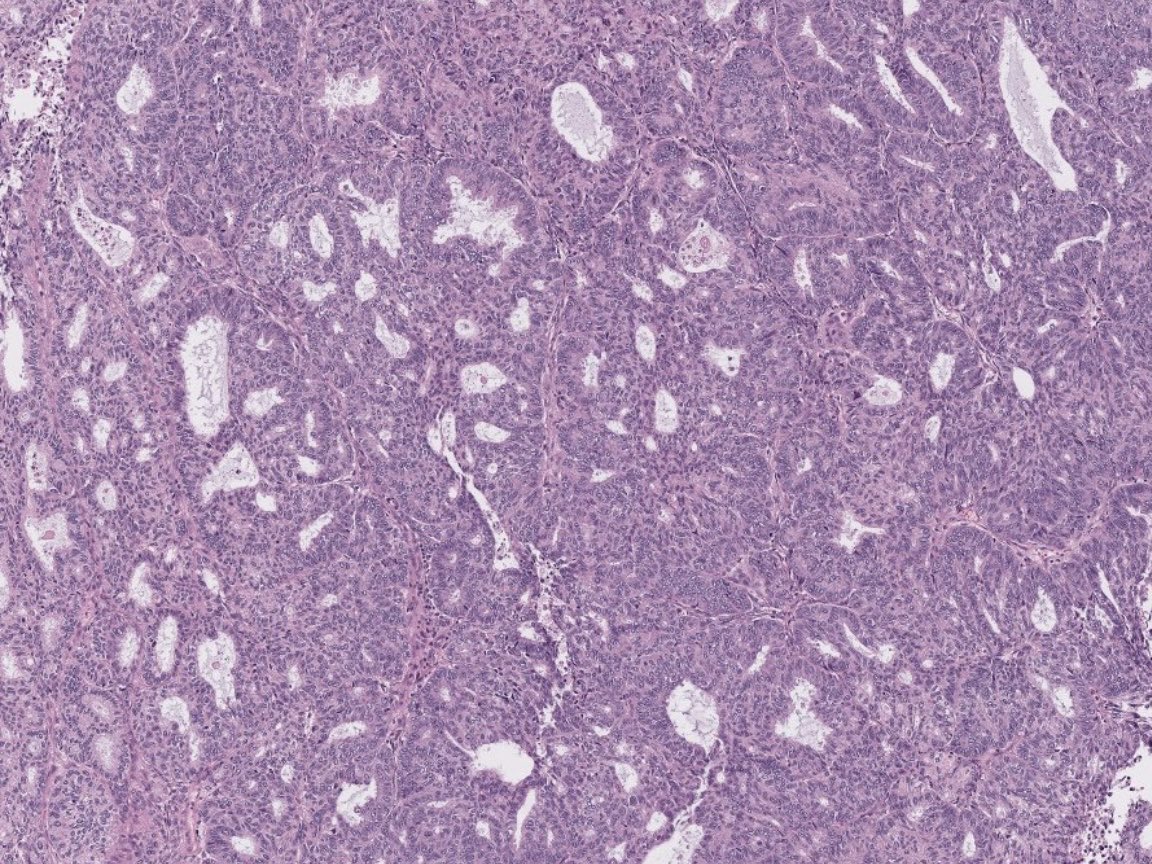 BrownPathology's tweet image. #Gynpath #Surgpath #pathresidents 
#Pathtwitter

Some images of an endometrioid-type adenocarcinoma of the ovary in a 60-year-old woman.
 
Mismatch repair proteins MLH1 and PMS2 show loss of staining (note negatively-staining tumor cell nuclei, with positively-stained stromal