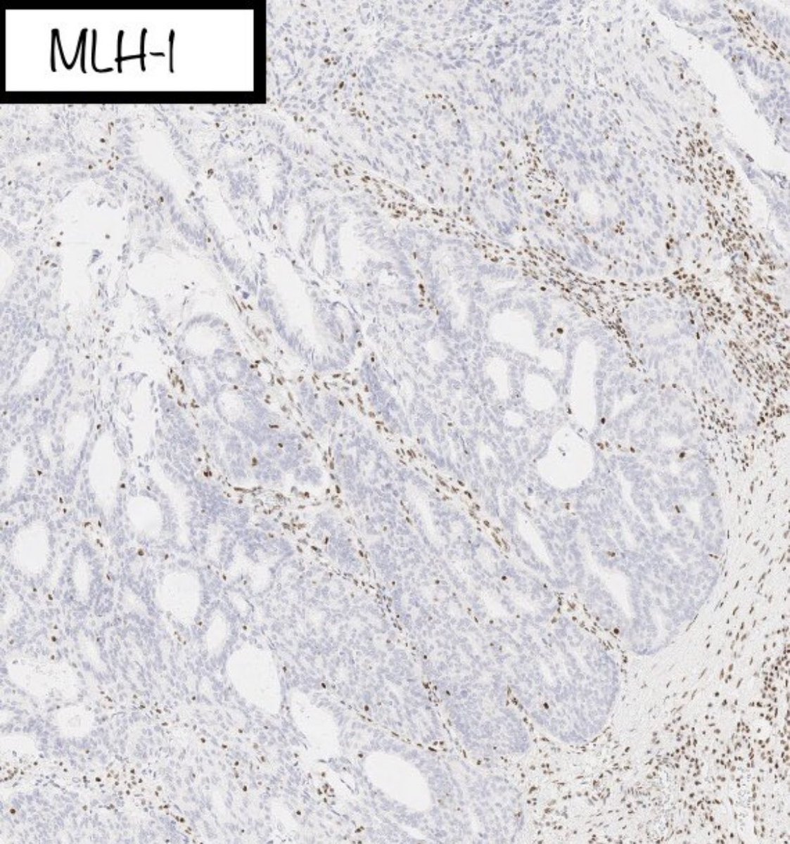 BrownPathology's tweet image. #Gynpath #Surgpath #pathresidents 
#Pathtwitter

Some images of an endometrioid-type adenocarcinoma of the ovary in a 60-year-old woman.
 
Mismatch repair proteins MLH1 and PMS2 show loss of staining (note negatively-staining tumor cell nuclei, with positively-stained stromal