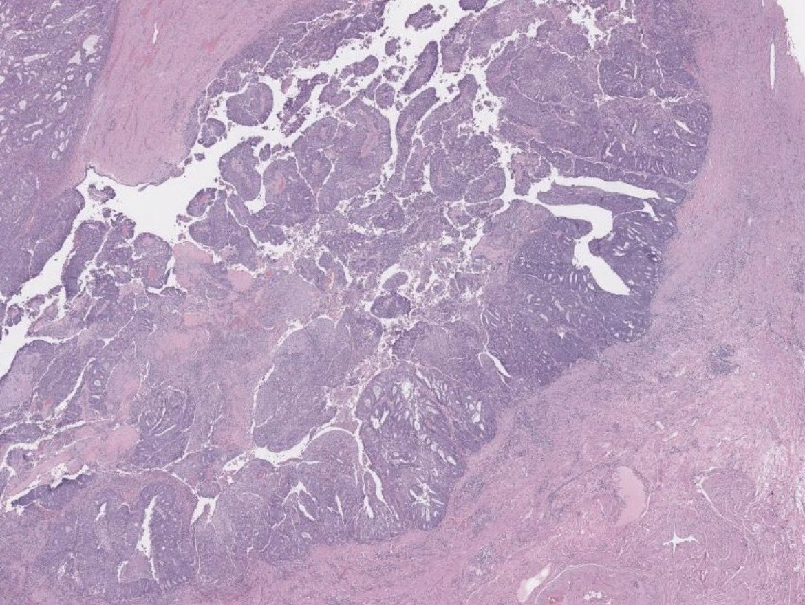 BrownPathology's tweet image. #Gynpath #Surgpath #pathresidents 
#Pathtwitter

Some images of an endometrioid-type adenocarcinoma of the ovary in a 60-year-old woman.
 
Mismatch repair proteins MLH1 and PMS2 show loss of staining (note negatively-staining tumor cell nuclei, with positively-stained stromal