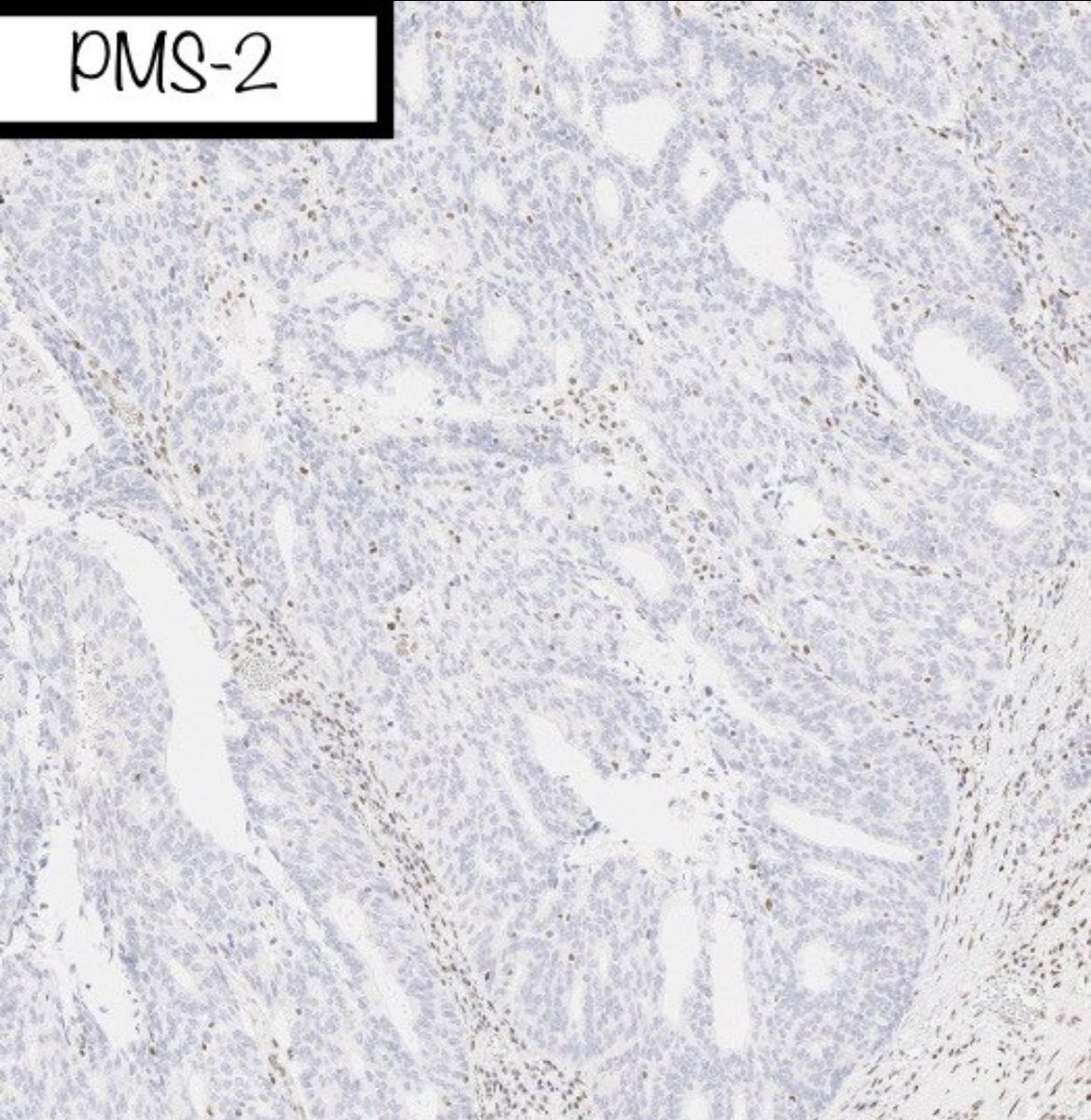 BrownPathology's tweet image. #Gynpath #Surgpath #pathresidents 
#Pathtwitter

Some images of an endometrioid-type adenocarcinoma of the ovary in a 60-year-old woman.
 
Mismatch repair proteins MLH1 and PMS2 show loss of staining (note negatively-staining tumor cell nuclei, with positively-stained stromal