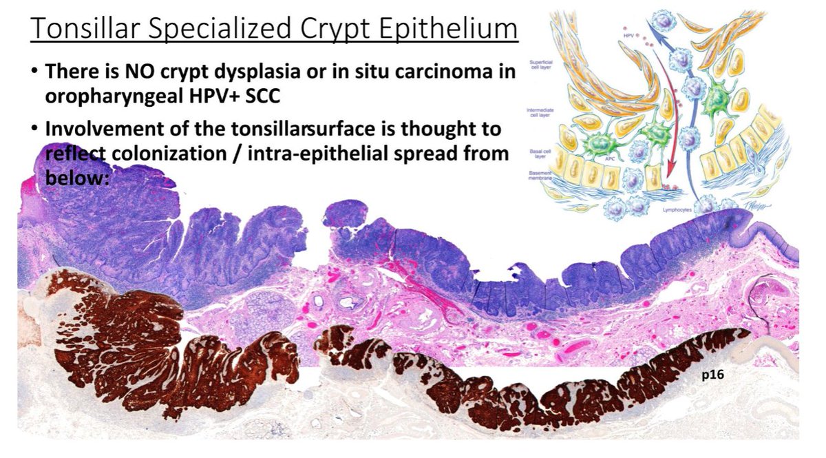 Janiranavarro's tweet photo. Oropharynx exophytic lesion: SCC?

Tonsillar crypts are lined by a unique reticulated epithelium. The basement membrane is disrupted and non-contiguous, allowing the epithelium easy access to lymphatics.

- There is no crypt dysplasia or in situ carcinoma in oropharyngeal HPV+ SCC.
- All HPV-related neoplasia of the tonsils should be regarded as malignant even in the absence of "classic" histologic features of invasion.

Dr. Cipriani #USCAP2026 #pathology #PathX #PathTwitter