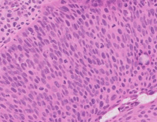 Janiranavarro's tweet photo. Oropharynx exophytic lesion: SCC?

Tonsillar crypts are lined by a unique reticulated epithelium. The basement membrane is disrupted and non-contiguous, allowing the epithelium easy access to lymphatics.

- There is no crypt dysplasia or in situ carcinoma in oropharyngeal HPV+ SCC.
- All HPV-related neoplasia of the tonsils should be regarded as malignant even in the absence of "classic" histologic features of invasion.

Dr. Cipriani #USCAP2026 #pathology #PathX #PathTwitter