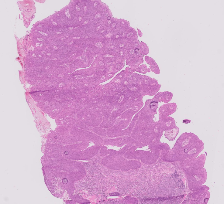 Janiranavarro's tweet photo. Oropharynx exophytic lesion: SCC?

Tonsillar crypts are lined by a unique reticulated epithelium. The basement membrane is disrupted and non-contiguous, allowing the epithelium easy access to lymphatics.

- There is no crypt dysplasia or in situ carcinoma in oropharyngeal HPV+ SCC.
- All HPV-related neoplasia of the tonsils should be regarded as malignant even in the absence of "classic" histologic features of invasion.

Dr. Cipriani #USCAP2026 #pathology #PathX #PathTwitter
