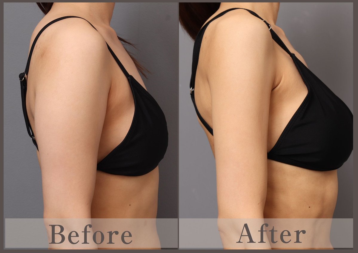 志田雅明 美容外科医|ハイブリッド豊胸・バービーウエスト・脂肪吸引・脂肪豊胸 tweet media