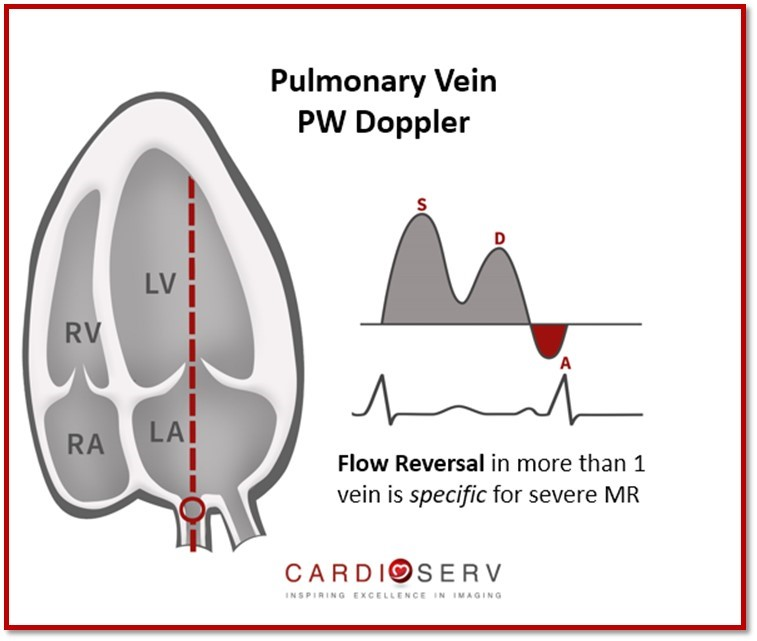 RitikaTuliMD's tweet photo. 🫀 CardioNugget: 

PV S/D Ratio in Diastology

Pulmonary vein Doppler tells you LA pressure 👇
🔹 S wave (systole) = LA relaxation (suction)
🔹 D wave (diastole) = LV filling

👉 Normal: S ≥ D (S/D ≥1)
👉 ↑ LV filling pressure: D > S (S/D <1) ⚠️

💡 S/D reversal = ↑ LA pressure → advanced diastolic dysfunction

#EchoBoards #CardioNuggets #Diastology #ASEGuidelines