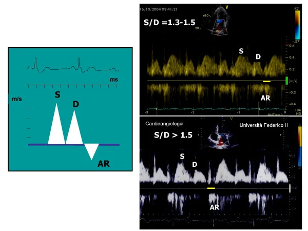 RitikaTuliMD's tweet photo. 🫀 CardioNugget: 

PV S/D Ratio in Diastology

Pulmonary vein Doppler tells you LA pressure 👇
🔹 S wave (systole) = LA relaxation (suction)
🔹 D wave (diastole) = LV filling

👉 Normal: S ≥ D (S/D ≥1)
👉 ↑ LV filling pressure: D > S (S/D <1) ⚠️

💡 S/D reversal = ↑ LA pressure → advanced diastolic dysfunction

#EchoBoards #CardioNuggets #Diastology #ASEGuidelines