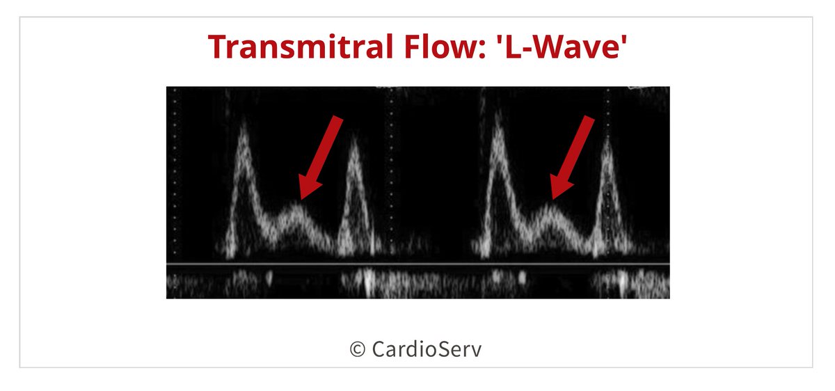 RitikaTuliMD's tweet photo. #CardioNugget:

L wave = extra filling wave between E & A (mid-diastole)

Not normal → suggests ↑ LV filling pressures + abnormal relaxation

Seen in advanced diastolic dysfunction

E–L–A pattern = abnormal filling

#CardioNuggets #EchoBoards #Diastology