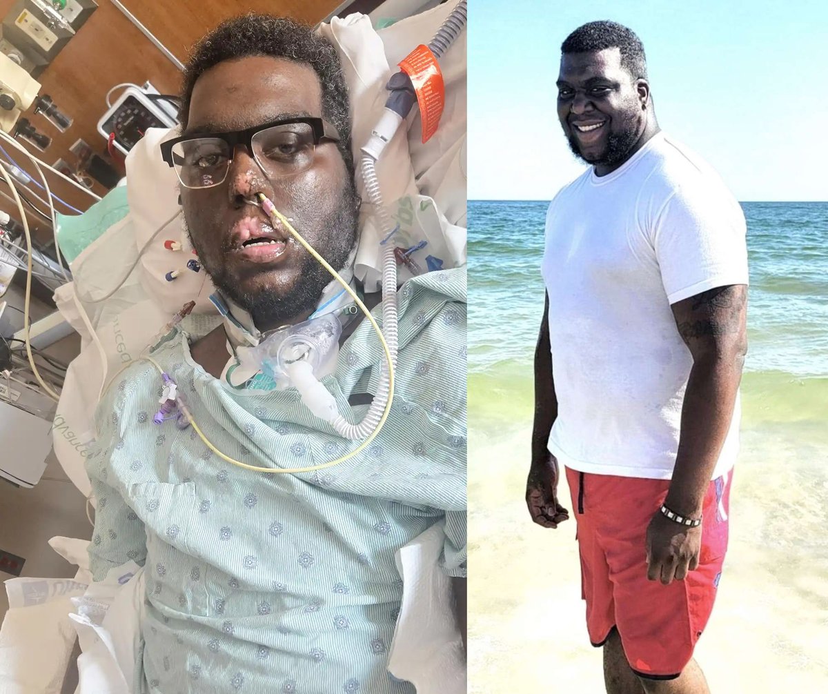 BlackNews's tweet image. Black Dad Has Limbs Amputated After Routine Dental Visit Triggers Gum Bleeding

blacknews.com/news/davon-van…

#blacktwitter #black #shocking #SHOCKED