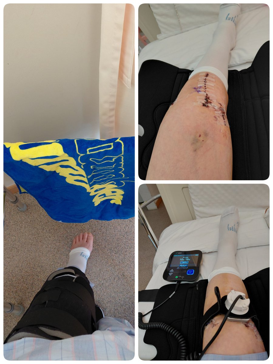 hinamaturi41030's tweet image. #back numberに会いに行く
傷を覆っていたシートも外れ、今日から超音波治療開始。
リハビリも日に日に難度が上がる。でも頑張るよ。
だってback numberに会いに行くんだもん。