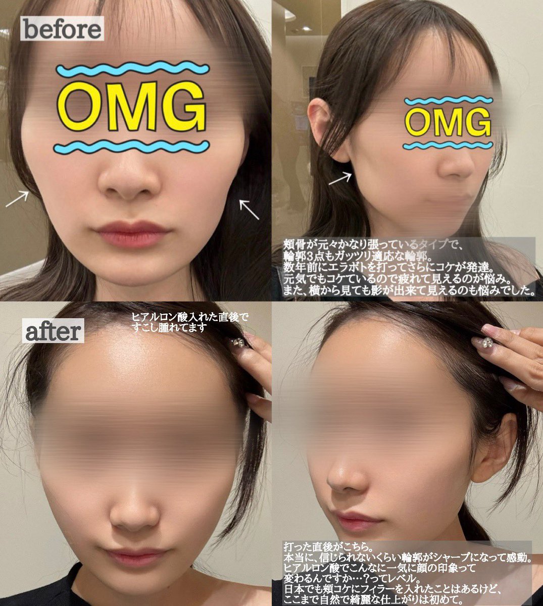 ykss_2141's tweet photo. ここまで1回のヒアルロン酸で感動することは多分もうない………頬骨が張ってて輪郭ピーナッツ🥜コケて見えるのが悩みで狎鴎亭にあるヒアルが得意なエイポクリニックに。超丁寧にデザインしてくれて痛みもほぼ無しだし上手すぎでは…？人違うレベルに輪郭変わった。頬コケ悩んでる人に本当おすすめ… https://t.co/fchquh6JcO