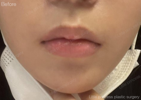 lpps_jp's tweet photo. 丁寧で詳しいカウンセリングと、院長先生の施術にご満足いただきありがとうございます
素敵なご感想、とても嬉しいです

オリニコンジュ美容整形外科💖

LINE相談=@793jjgaa

#オリンコンジュ整形外科 #唇フィラー #唇整形 #渡韓 #韓国整形 #口角ボトックス #フィラー #唇ヒアルロン酸 #唇 #唇ヒアル https://t.co/eFPhgvBMOD