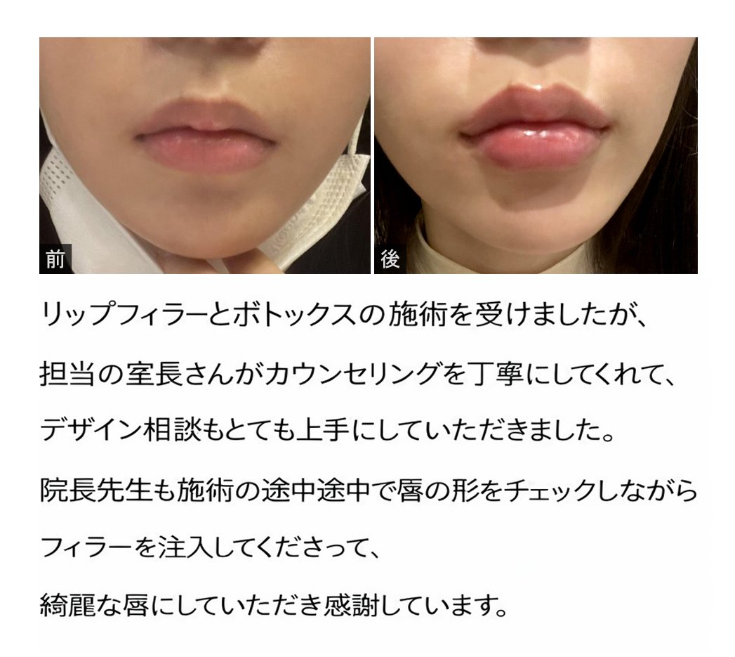 lpps_jp's tweet photo. 丁寧で詳しいカウンセリングと、院長先生の施術にご満足いただきありがとうございます
素敵なご感想、とても嬉しいです

オリニコンジュ美容整形外科💖

LINE相談=@793jjgaa

#オリンコンジュ整形外科 #唇フィラー #唇整形 #渡韓 #韓国整形 #口角ボトックス #フィラー #唇ヒアルロン酸 #唇 #唇ヒアル https://t.co/eFPhgvBMOD
