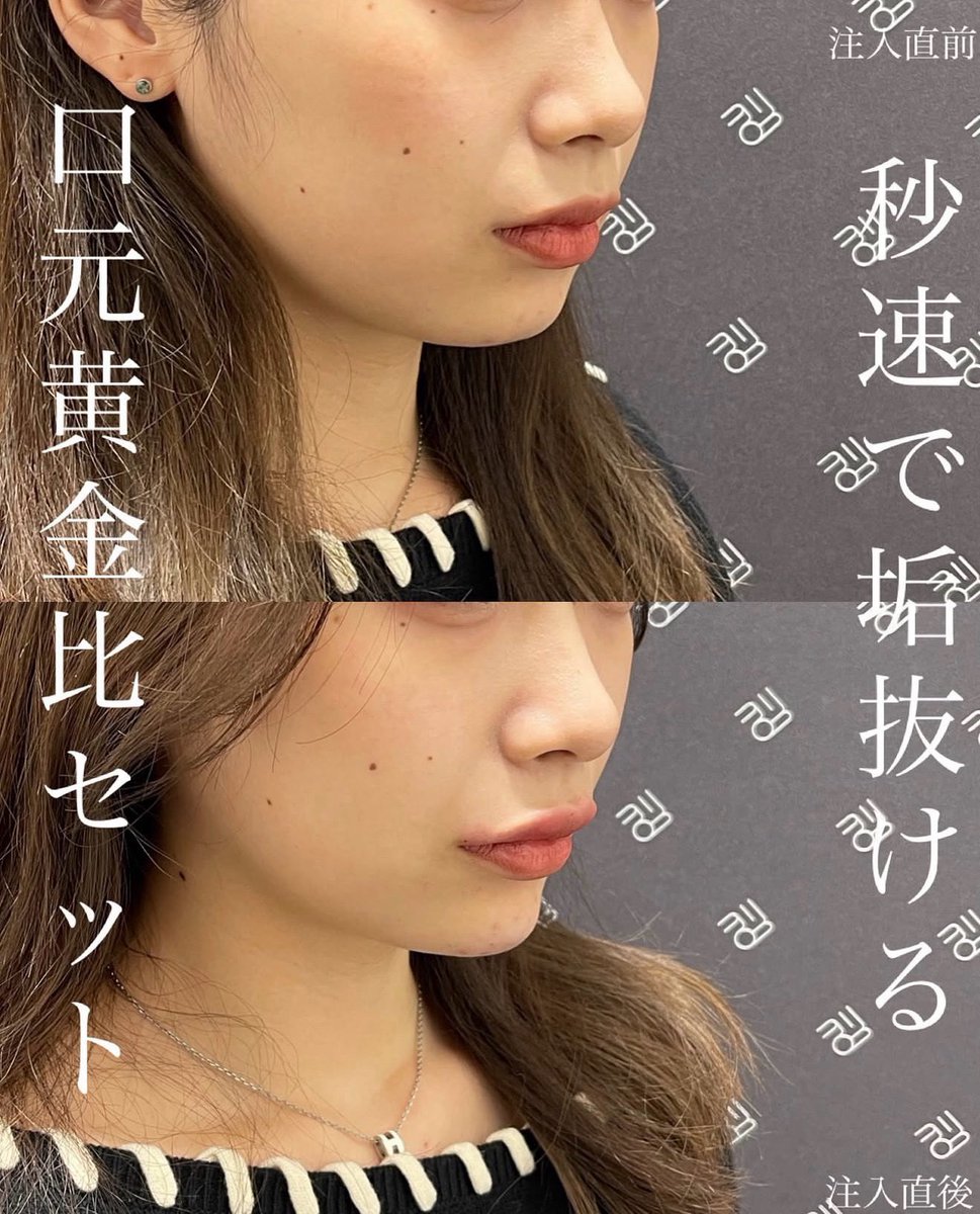 なおき先生👨‍⚕️クマ脂肪注入専門 tweet media