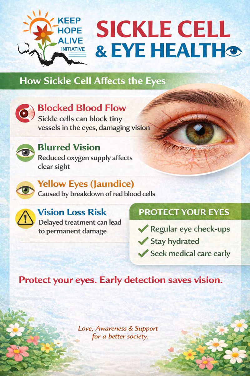 KeepHopeAliveCB's tweet photo. SICKLE CELL &amp; EYE HEALTH 👁️
Sickle cell disease does not only affect the blood it can also have serious effects on the eyes and vision.
Keep Hope Alive CBO
Love, Awareness &amp; Support for a better society ❤️
#SickleCellAwareness #EyeHealthMatters #KeepHopeAlive #Health https://t.co/xtcBNyan0C