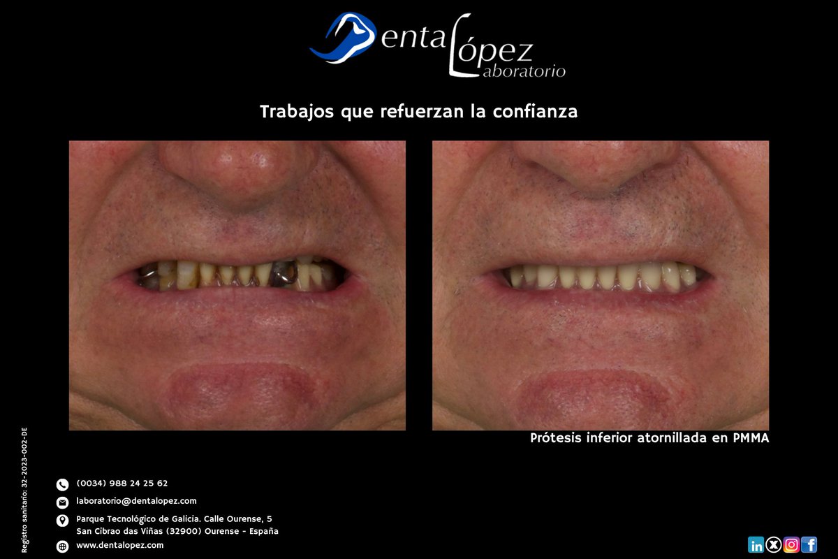 DentaLopez's tweet photo. Antes y después.
Prótesis inferior atornillada en PMMA: ajuste, función y estabilidad desde el inicio.
#PMMA #protesisdental #implantologia #laboratoriodental #DentalLópez https://t.co/cDoz7trlBU