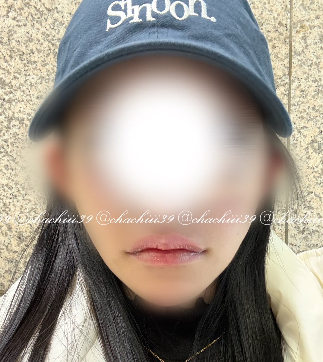 ちゃ❕DT眉下傷跡修正 逆さまつげ修正 𝐍𝐞𝐱𝐭二重修正 豊胸 tweet media
