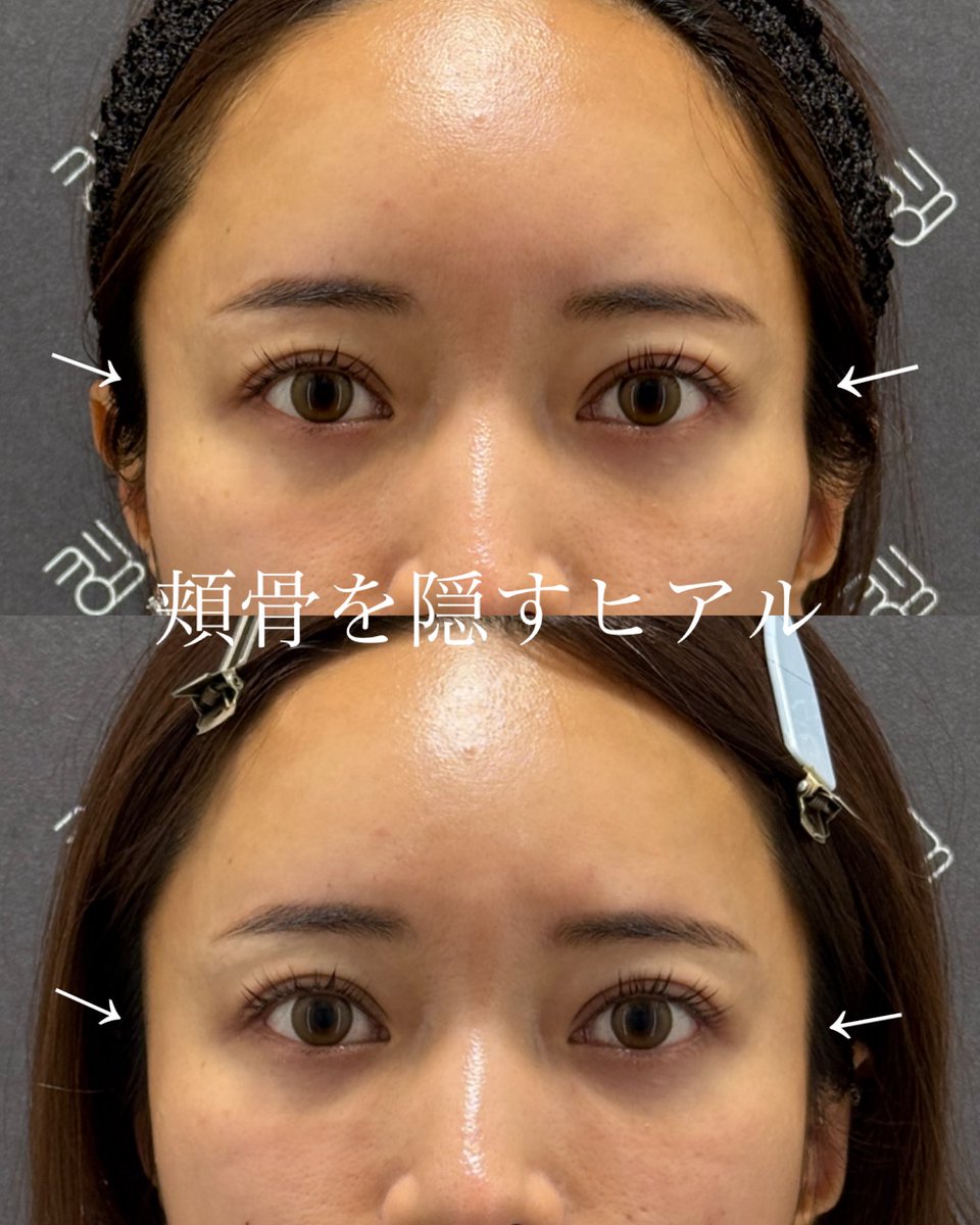 なおき先生👨‍⚕️クマ脂肪注入専門 tweet media