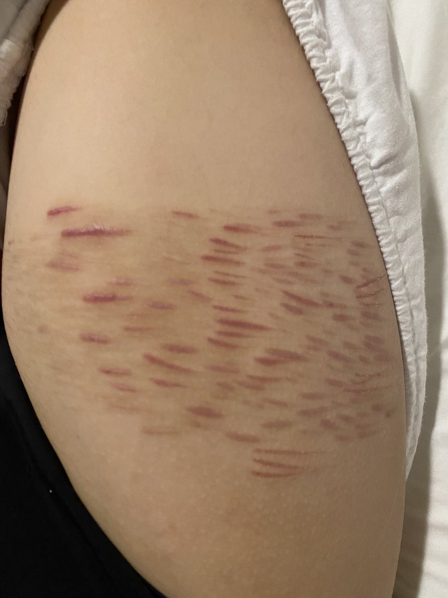 iyakawaiichan's tweet image. i think some of my scars are fading im so sad anyway scar check
#scarspo ????🥺 #scars #shtwt #selfharm #sh