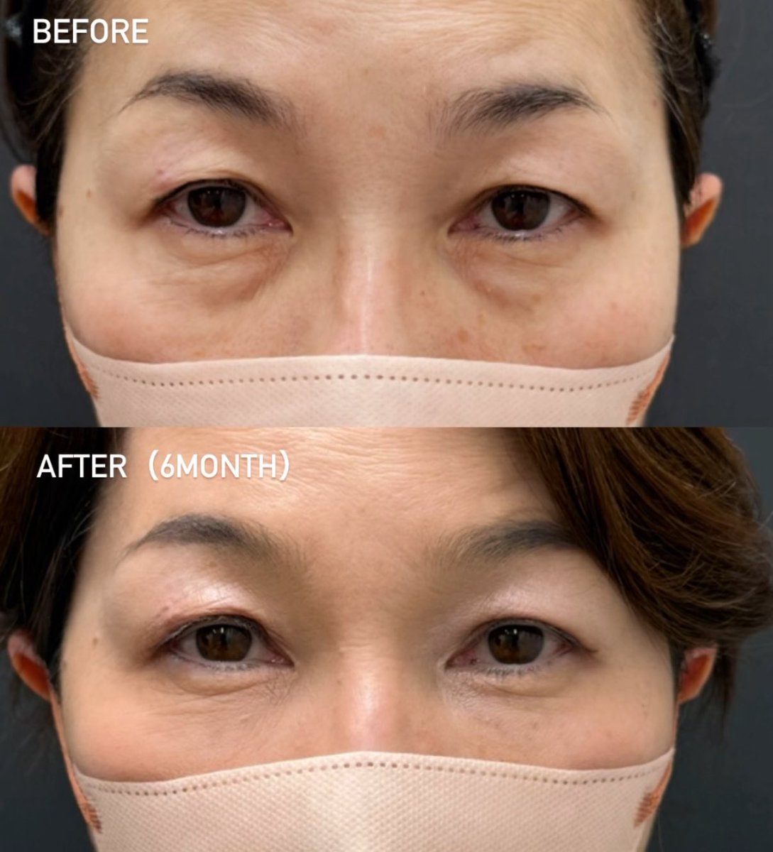 ApollonClinic's tweet photo. 目の下のクマを取る「裏ハムラ法」
疲れ顔や老け顔改善ならわだまり��お任せください✨ https://t.co/uABqxwJZGU