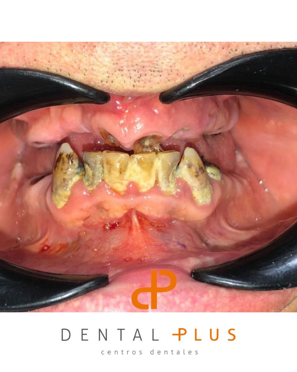DentalplusPLUS's tweet photo. 😬Pensó que su boca sería así para siempre
Su vida ha cambiado por completo! El paciente llegó a consulta con quistes e infecciones. Se le extrajeron todos y se le montó una dentadura removible arriba y una fija en la inferior
Lo que parece imposible, solo necesita buenas manos🦷 https://t.co/2Wd7PmsSoc