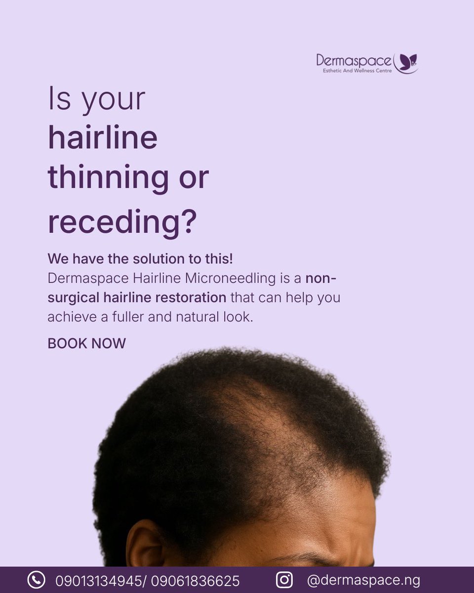 Thinning or receding hairline doesn’t have to be something you “just live with.”
With the right approach, you can encourage healthier growth and bring back that fuller, natural look over time.

Seems like the service you’re looking for? Kindly DM or Call/WhatsApp 09013134945