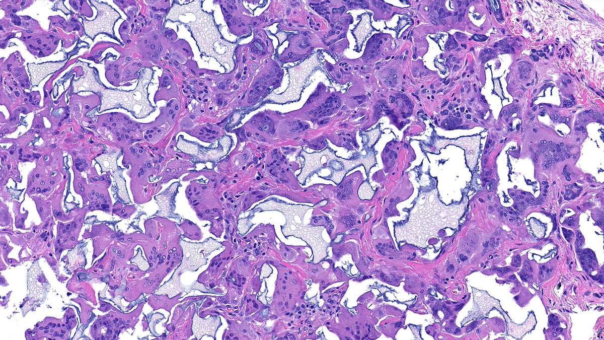 RazaHoda's tweet image. Biopsy Marker Gel 🫧🔬

Amorphous extracellular material employed during needle core biopsy to help prevent clip migration.

#PathX #PathTwitter #breastpath #PathArt