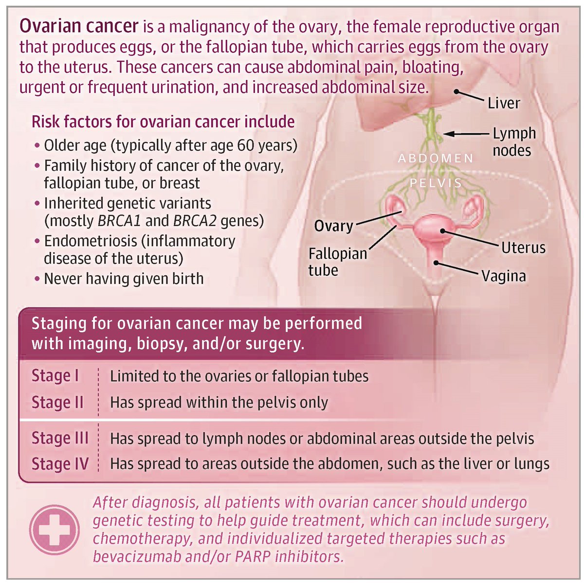 JAMA_current's tweet image. Among women worldwide, #OvarianCancer is the eighth most common malignancy and cause of cancer death. 

📄 This JAMA Patient Page describes ovarian cancer and its risk factors, symptoms, diagnosis, and treatment. 

ja.ma/41eEKM7