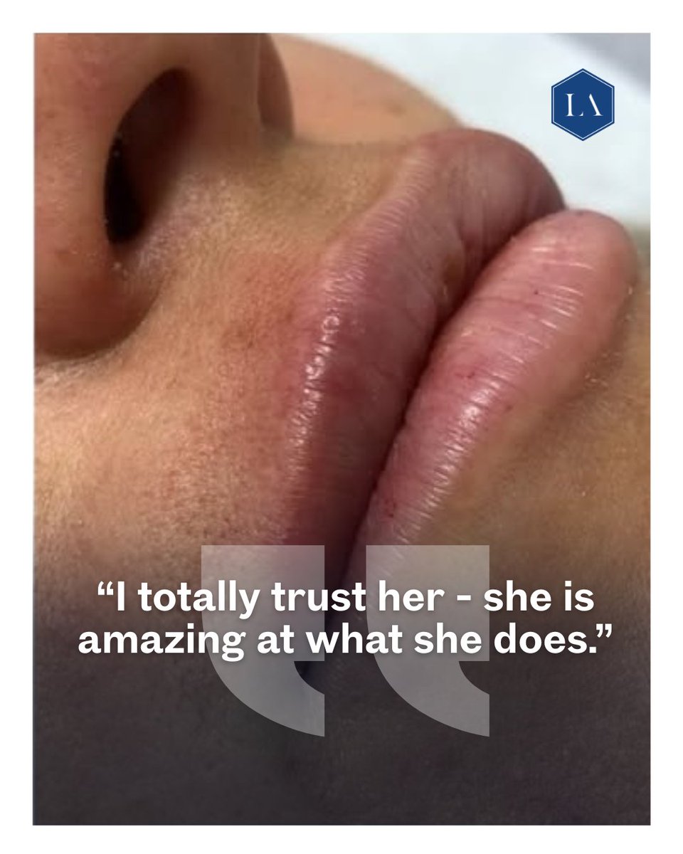 My aim is always natural, beautiful results and clients who feel confident and looked after from consultation to aftercare. 

#ClientReview  #AestheticsClinic  #EssexClinics #KentClinics #LondonAesthetics