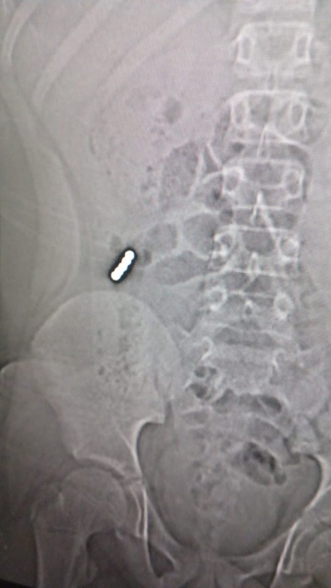 Un menor de once años tras intensos dolores abdominales debió ser operado por culpa del "Challange de RRSS de  ingerir imanes", esto puede producir obstrucción intestinal, lesiones por isquemia de la mucosa y submucosa, perforaciones y peritonitis. Ya son 7 menores operados en