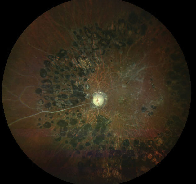 revoptom's tweet image. Study: PRP Still Used for PDR in 60% of Cases Despite Rise of Anti-VEGF

Traits of those most likely to receive the laser treatment include high-risk for lapse in case, minority/disadvantaged status, younger age and better baseline VA.
reviewofoptometry.com/article/study-…
#retina #optometry