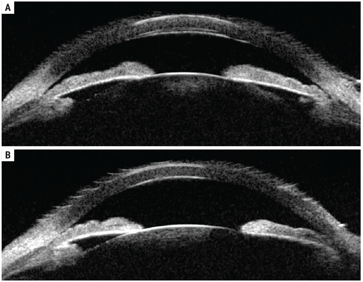 revoptom's tweet image. Moderate PACG May Be Most Vulnerable to Rapid Functional Loss

Older age, axial length and IOP variability shaped progression risk differently across disease stages.
reviewofoptometry.com/news/article/m…

#glaucoma #optometry #eyecare