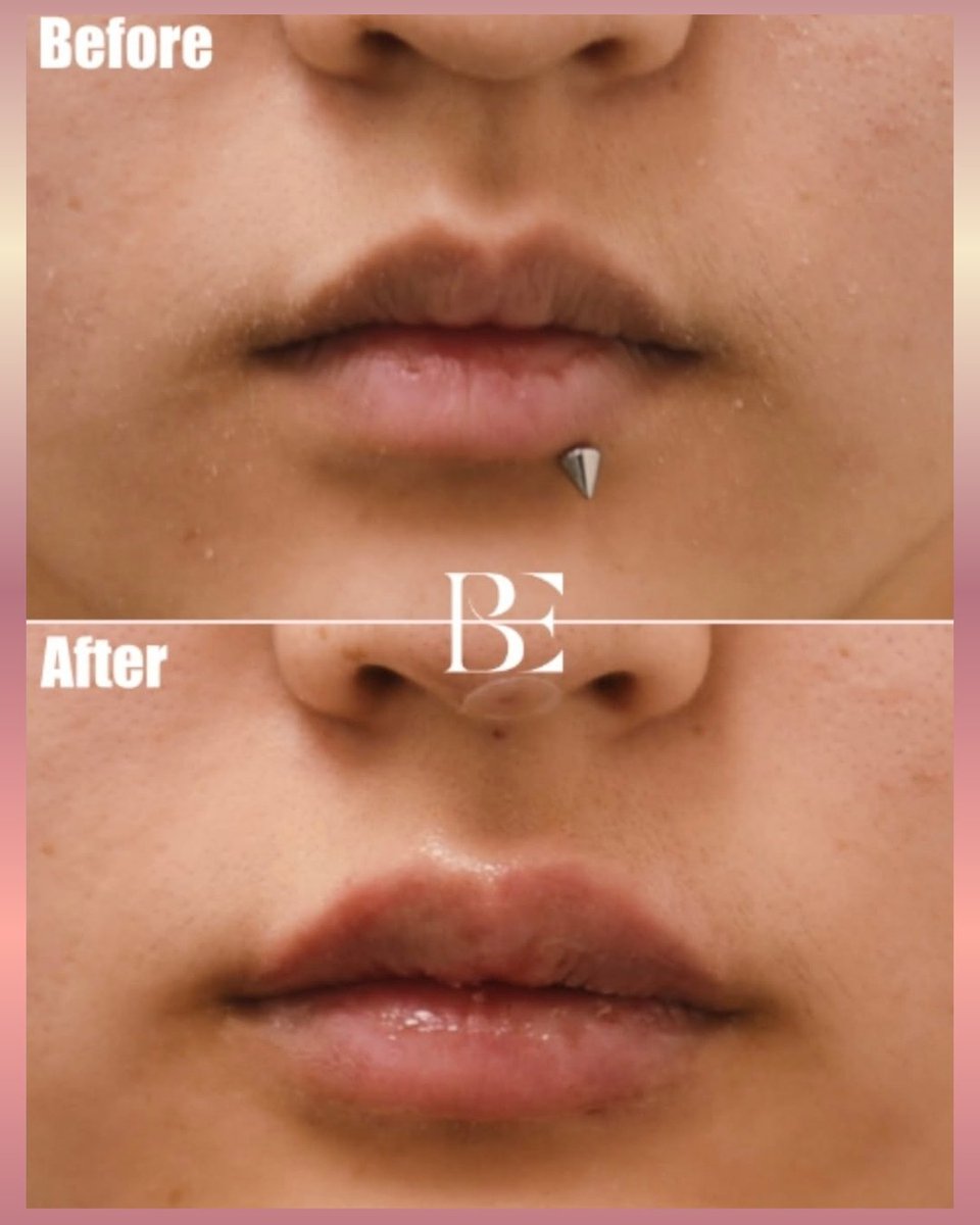 ビヨンド クリニック🤍フィラー・リフティング・アンチエイジング専門🪷 tweet media