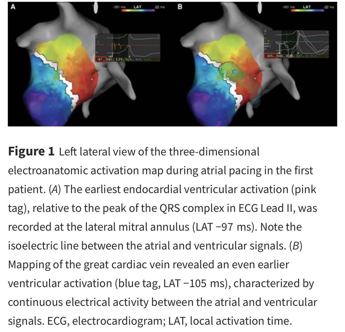 ESC_Journals's tweet image. Epicardial left lateral accessory pathways: an uncommon cause of ablation failure ow.ly/lmJx50YEB2w

#EHJCaseReports @Phiso_de @TJ_Yeo @aayshacader @BoldiKovacsMD @SukritiBanthiya @ANazmiCalik @O_Azizy_MD @saramoscatelli7 @EHJCREiC #CardioX