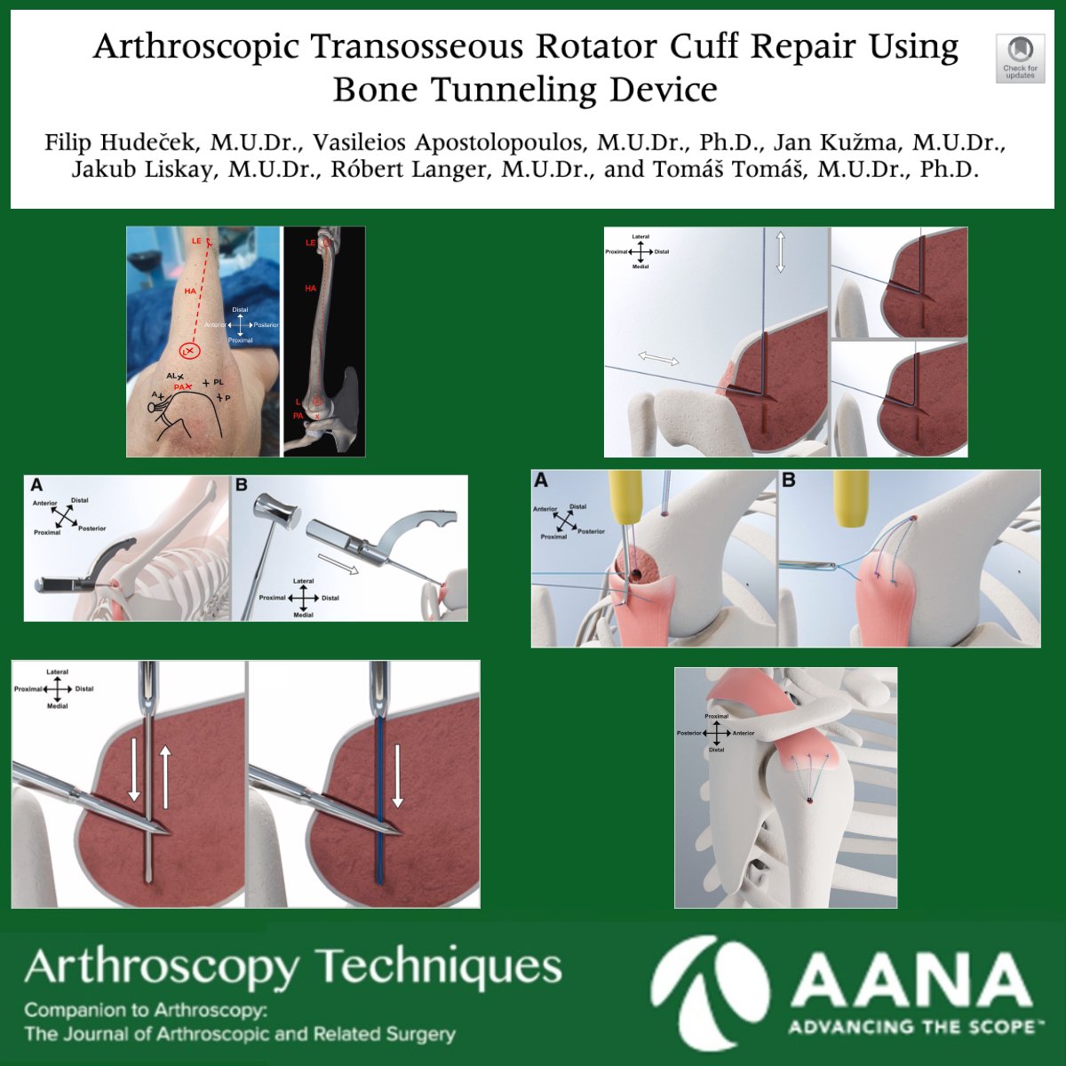 ArthroscopyJ's tweet image. No anchors? No problem. This technique demonstrates an effective way to enhance the feasibility and affordability of implant-free transosseous rotator cuff repair via a novel bone tunneling device. 

…scopyjournals.onlinelibrary.wiley.com/doi/10.1016/j.…