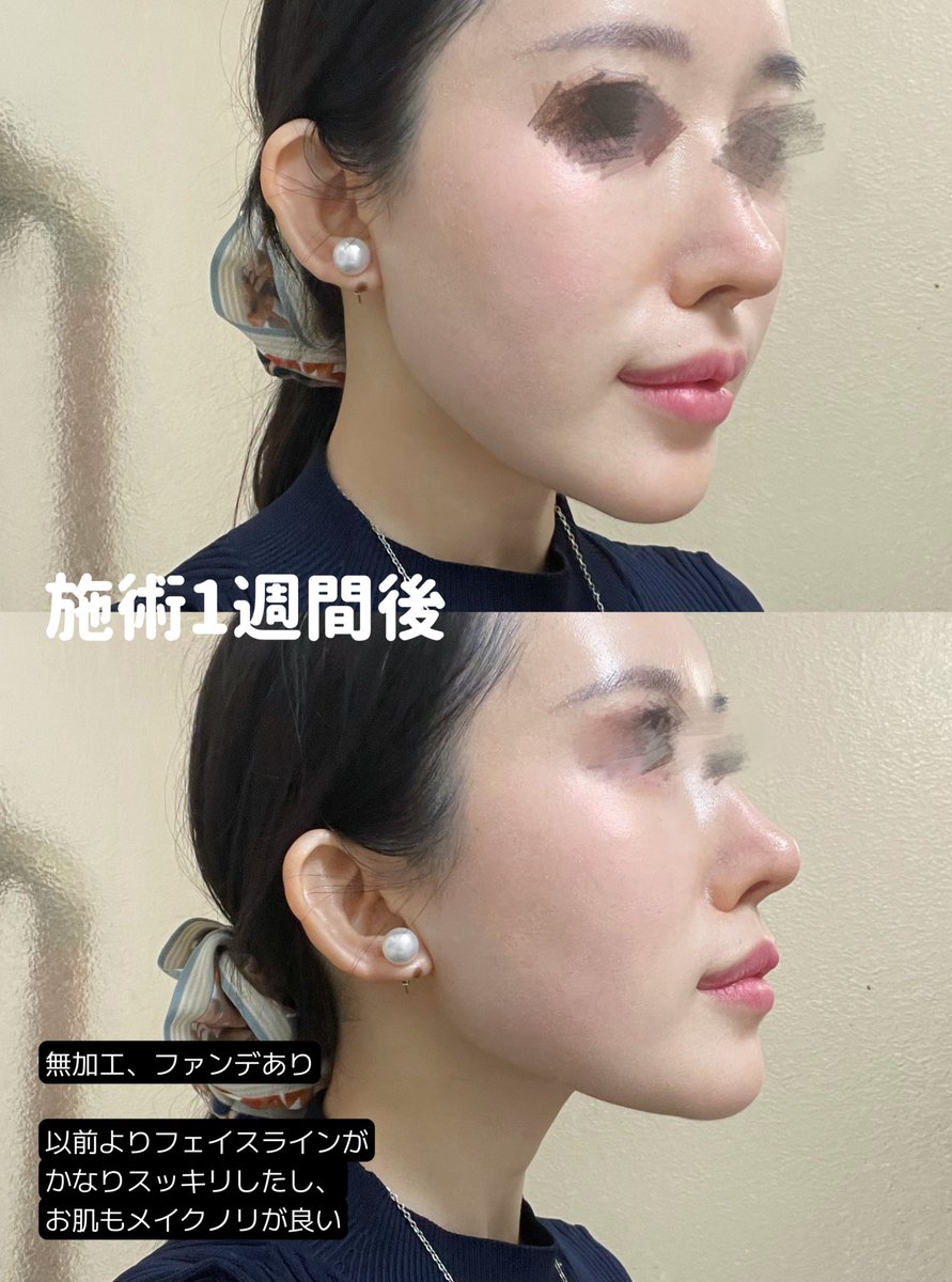 ごりちゃん🇰🇷4/21-4/22脂肪豊胸DT tweet media